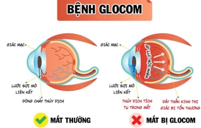 BỆNH GLOCOM: 