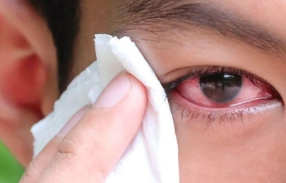 ĐỪNG CHỦ QUAN VỚI DỊ VẬT BẮN VÀO MẮT. NGUY CƠ MÙ LÒA TỪ NHỮNG VẬT NHỎ BÉ