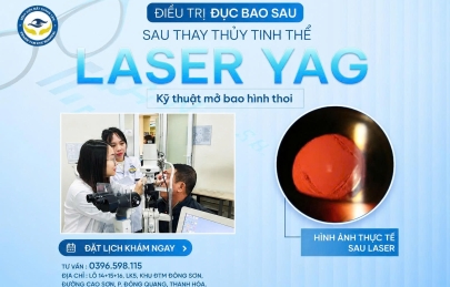 ĐIỀU TRỊ ĐỤC BAO SAU BẰNG LASER YAG: GIẢI PHÁP KHÔI PHỤC THỊ LỰC SAU THAY THỦY TINH THỂ