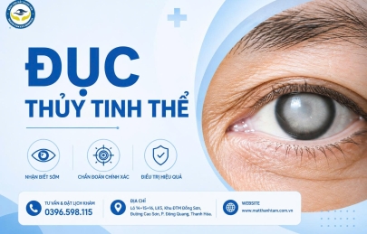 ĐỤC THỦY TINH THỂ (CƯỜM KHÔ): DẤU HIỆU NHẬN BIẾT VÀ PHƯƠNG PHÁP ĐIỀU TRỊ KHÔNG ĐAU